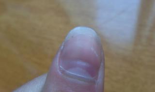 手指甲上有黑色竖纹 手指甲上有黑色竖纹