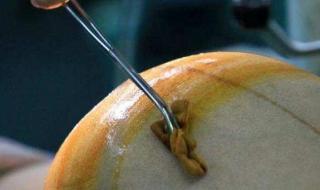 刨妇产大概需要多少钱 刨妇产大概需要多少钱